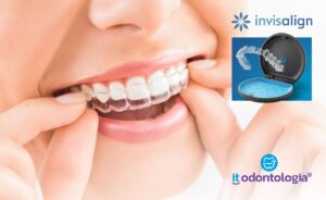 Invisalign no Belenzinho com Tecnologia e Conforto